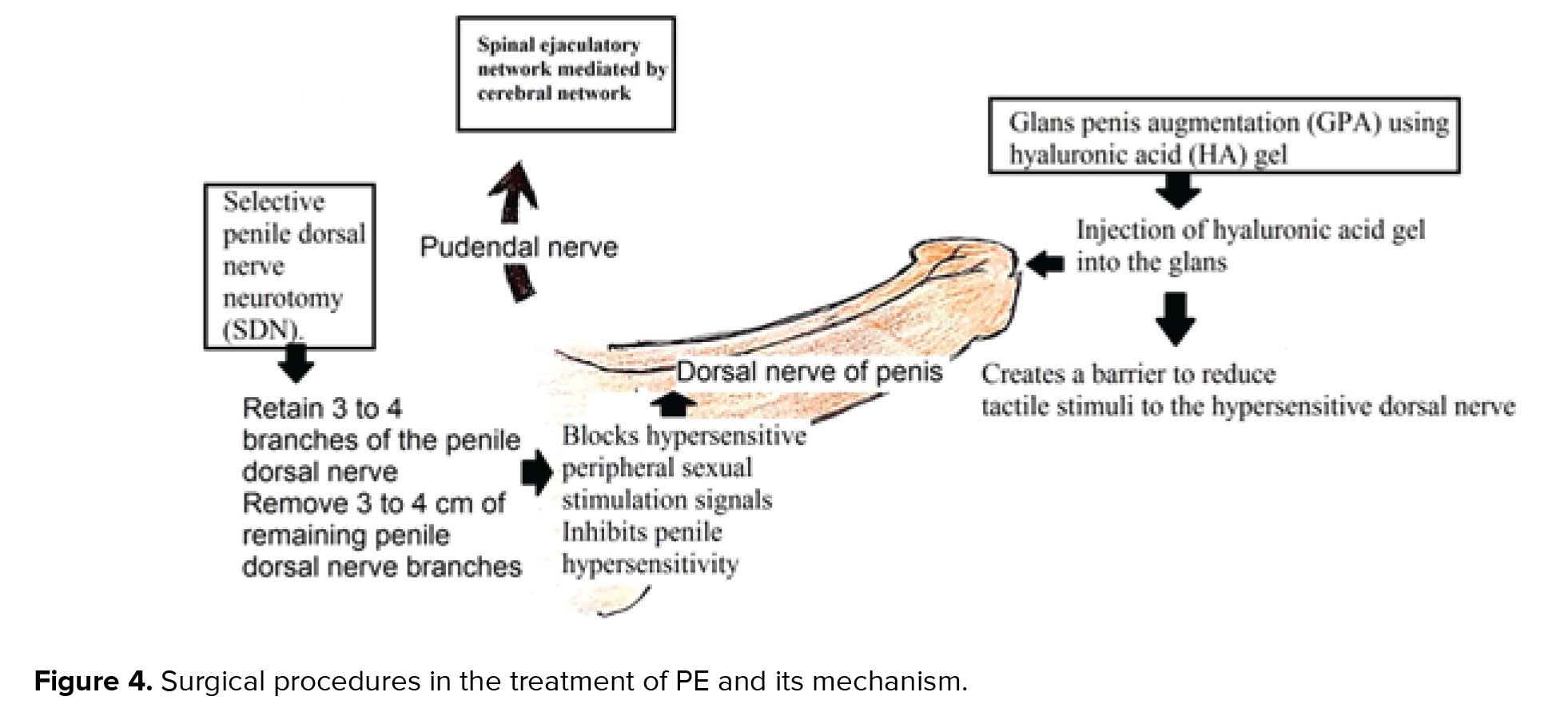 Premature ejaculation current concepts in the management A